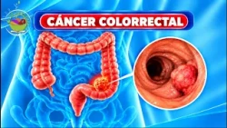 CÁNCER COLORRECTAL