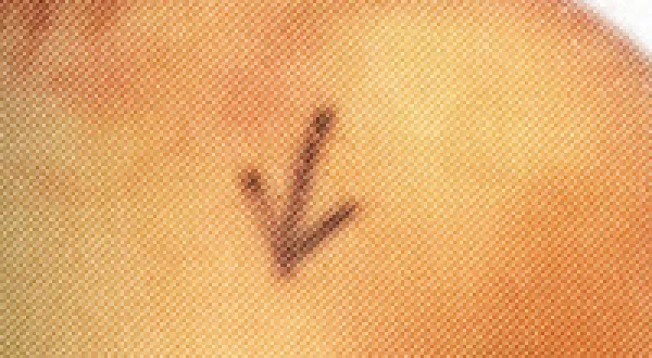 Breast Cancer Scandal: Exposing the Harm