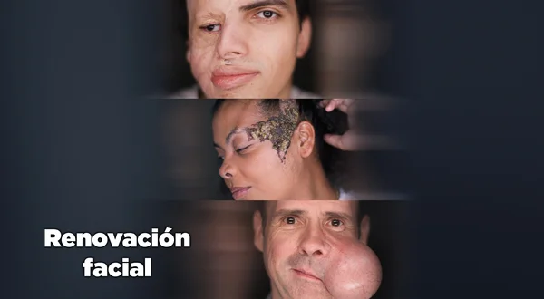 Renovación facial